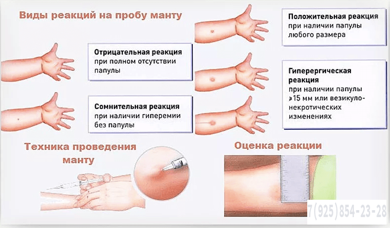 Реакция Манту расшифровка